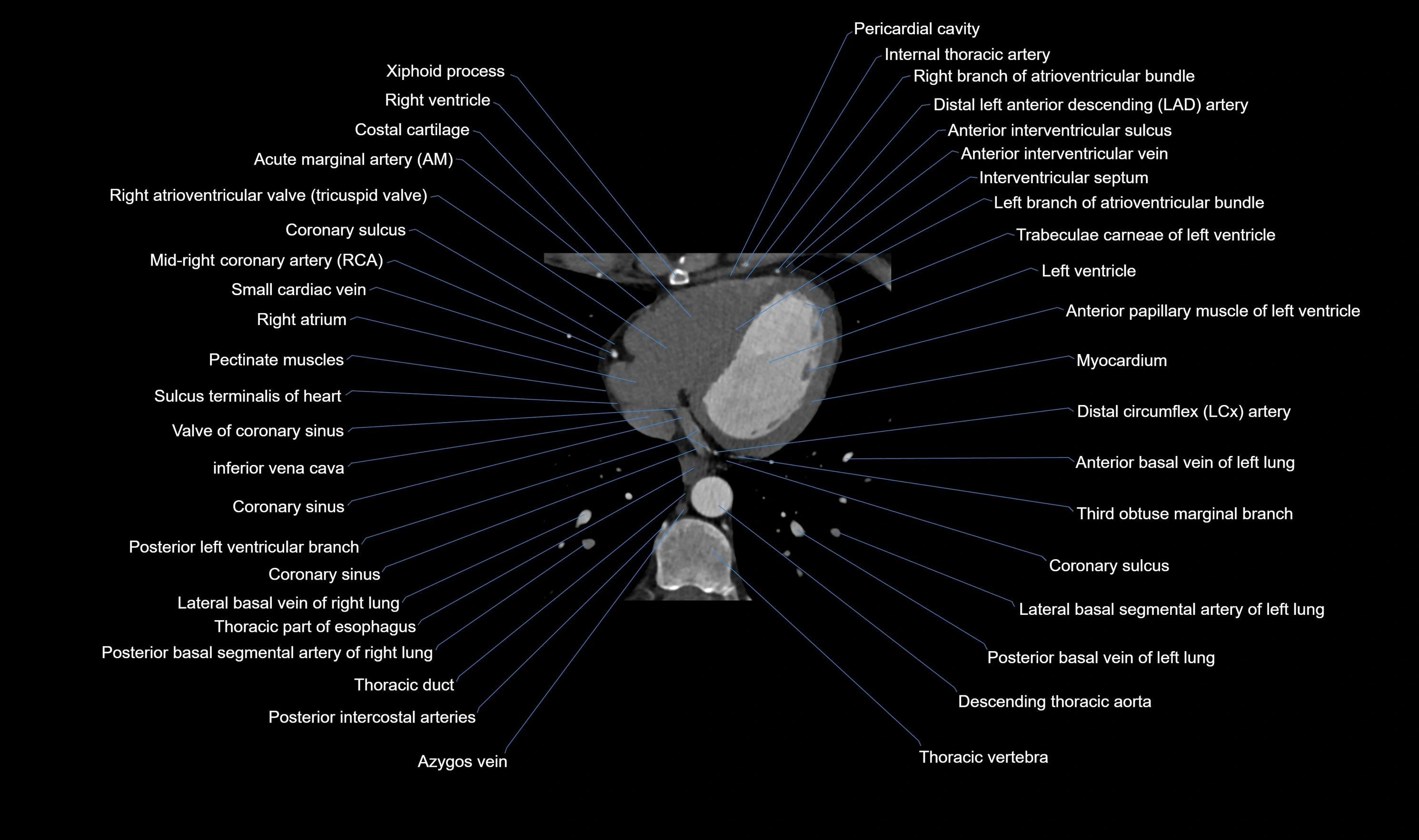 CT heart (coronary angiogram) axial view cross sectional anatomy labelled radiology image-00050.webp